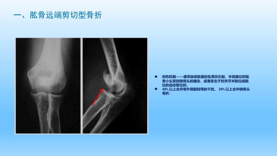 外科学：剪切型骨折的治疗_第4页