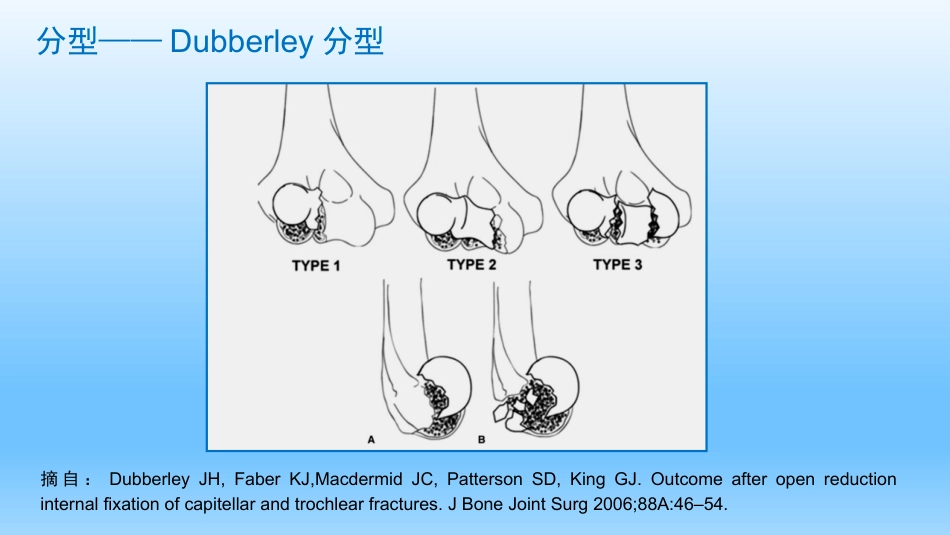 外科学：剪切型骨折的治疗_第5页