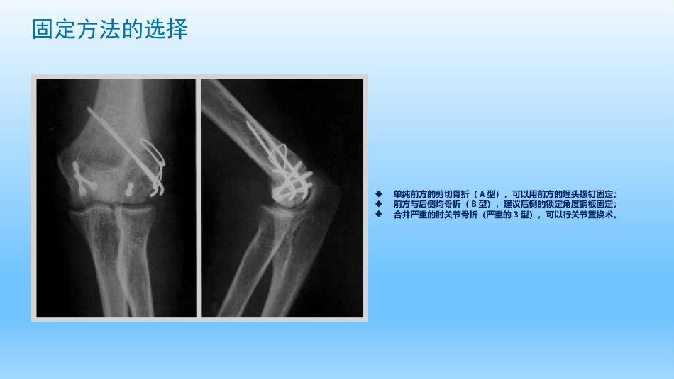 外科学：剪切型骨折的治疗_第6页