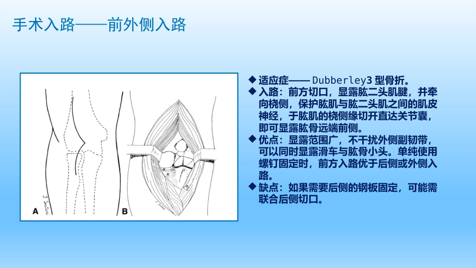外科学：剪切型骨折的治疗_第8页