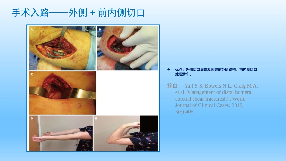 外科学：剪切型骨折的治疗_第9页