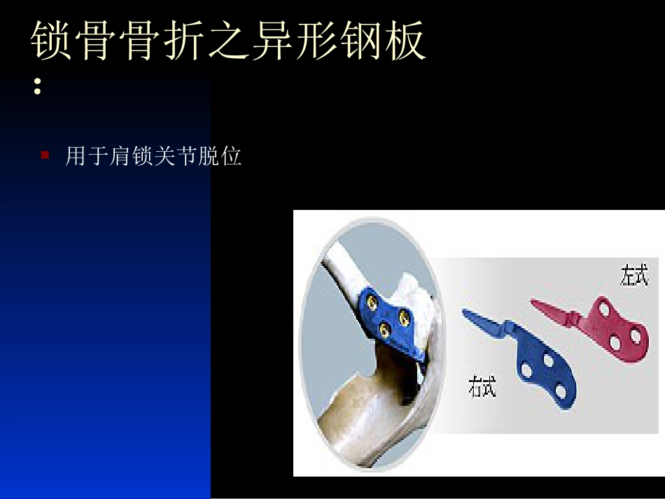 外科学：骨科常用内固定器械_第14页
