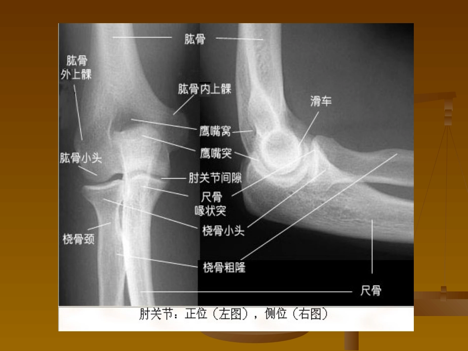外科学：肘关节恐怖三联征._第12页