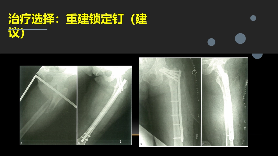 外科学：股骨粗隆下骨折_第10页