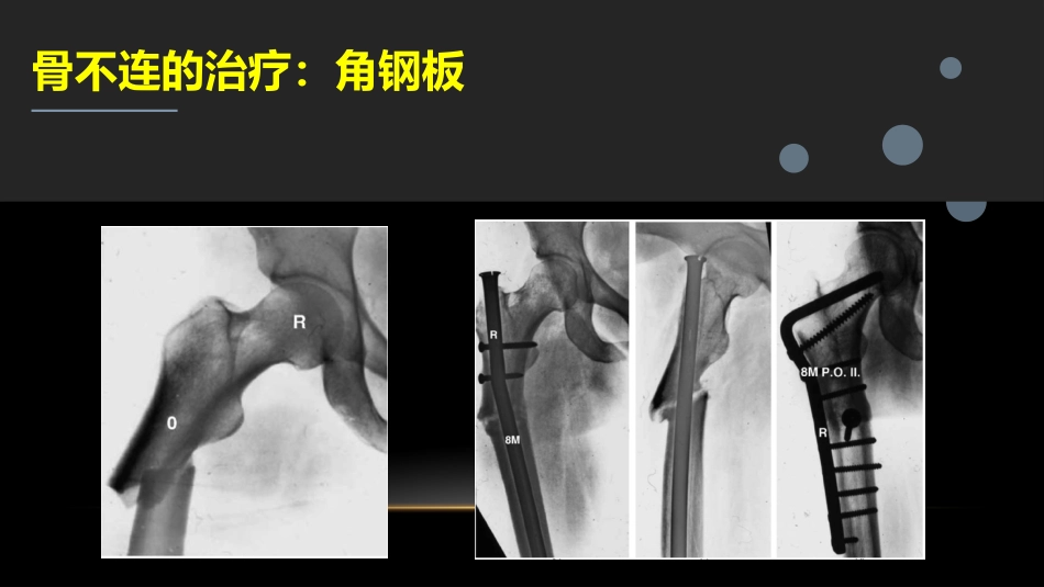 外科学：股骨粗隆下骨折_第13页
