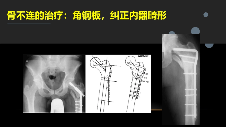 外科学：股骨粗隆下骨折_第14页
