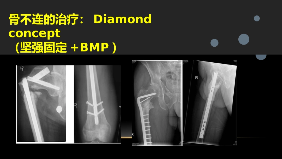 外科学：股骨粗隆下骨折_第15页