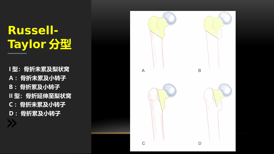 外科学：股骨粗隆下骨折_第2页