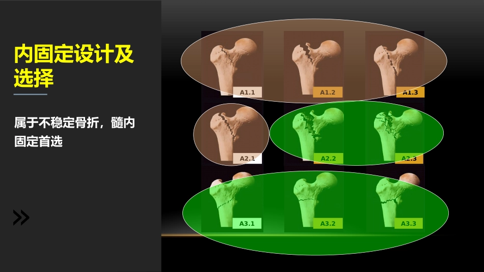 外科学：股骨粗隆下骨折_第7页