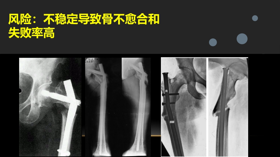 外科学：股骨粗隆下骨折_第8页