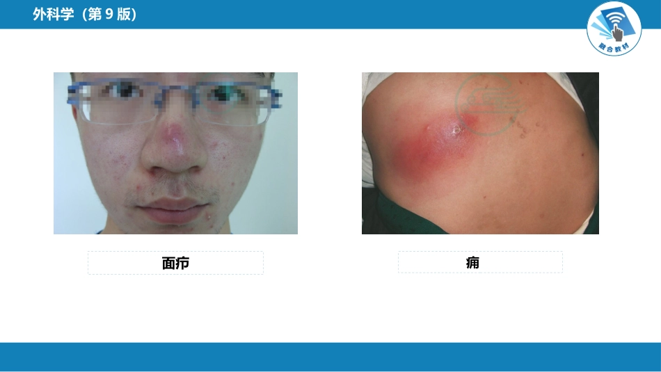 外科学：外科感染_第7页