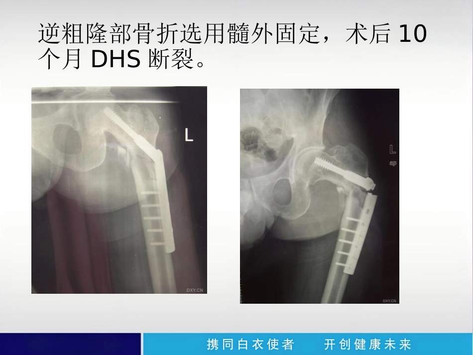 外科学：内植物断裂原因分析_第10页