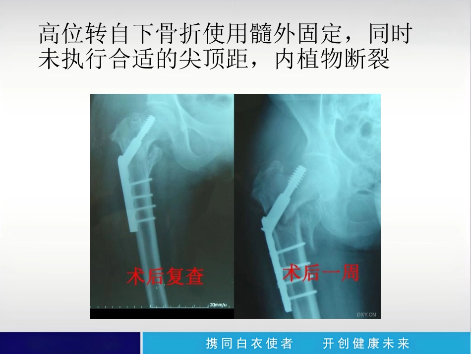外科学：内植物断裂原因分析_第11页