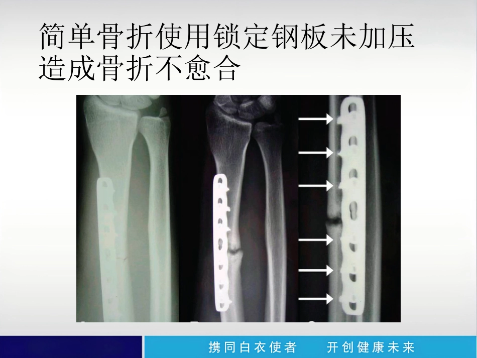 外科学：内植物断裂原因分析_第12页