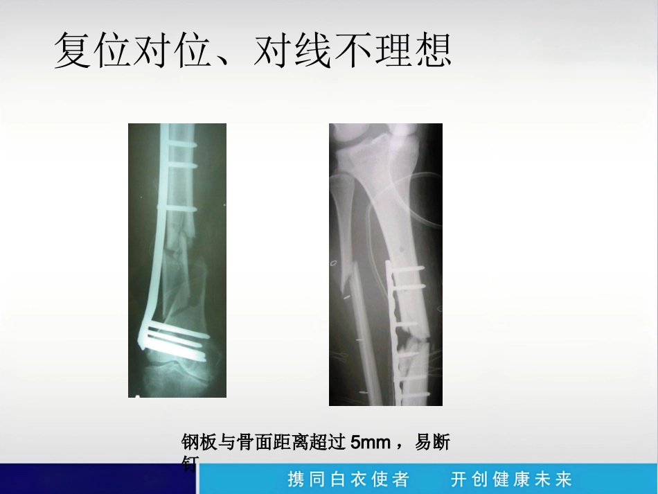 外科学：内植物断裂原因分析_第13页