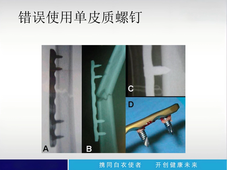 外科学：内植物断裂原因分析_第14页