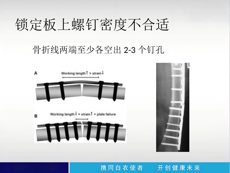 外科学：内植物断裂原因分析_第15页
