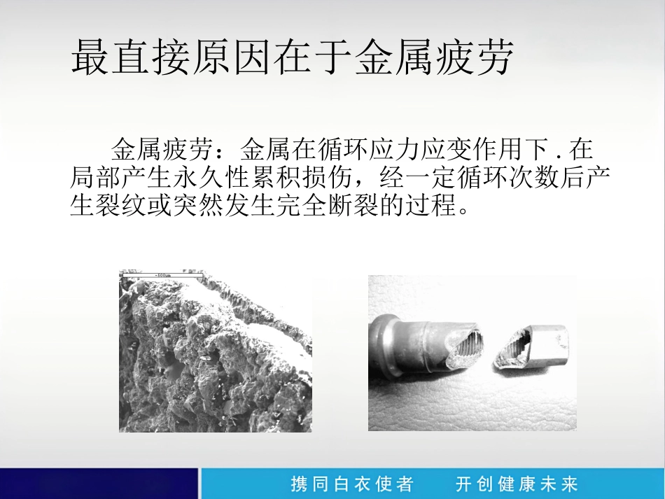 外科学：内植物断裂原因分析_第2页