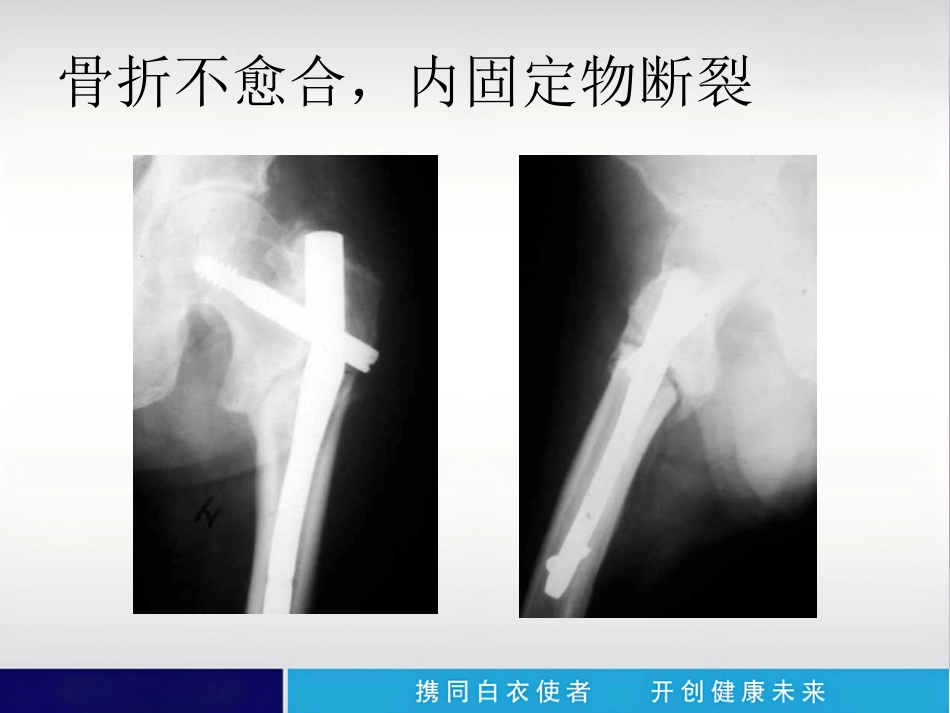 外科学：内植物断裂原因分析_第5页