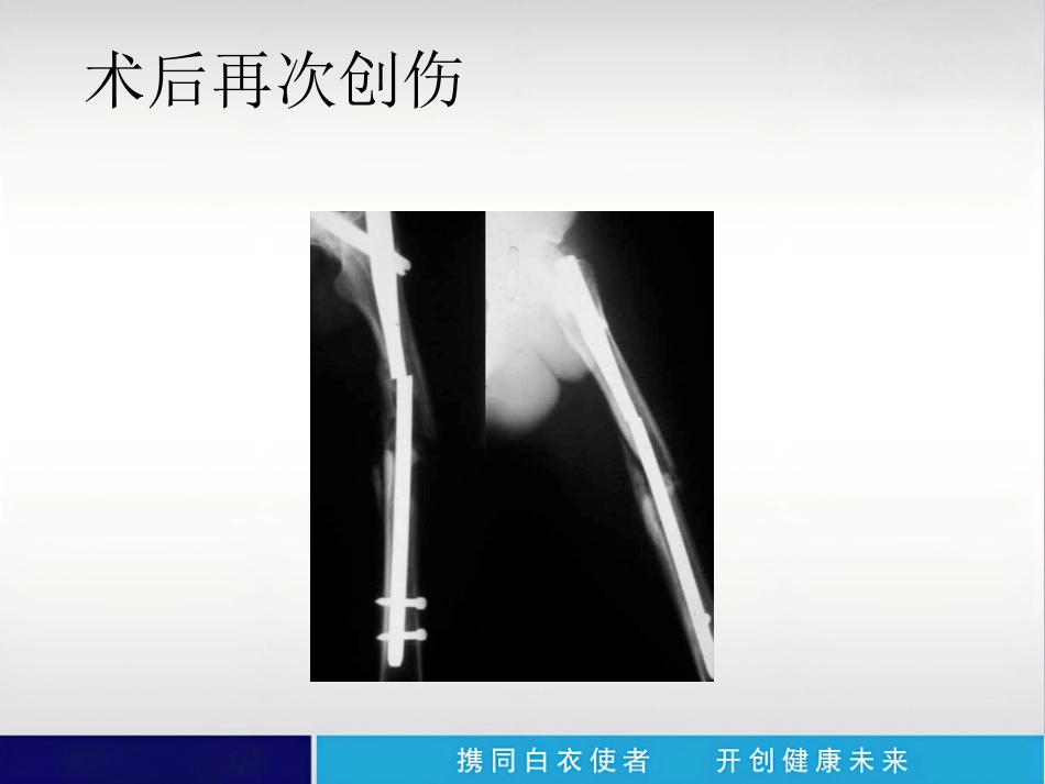 外科学：内植物断裂原因分析_第7页