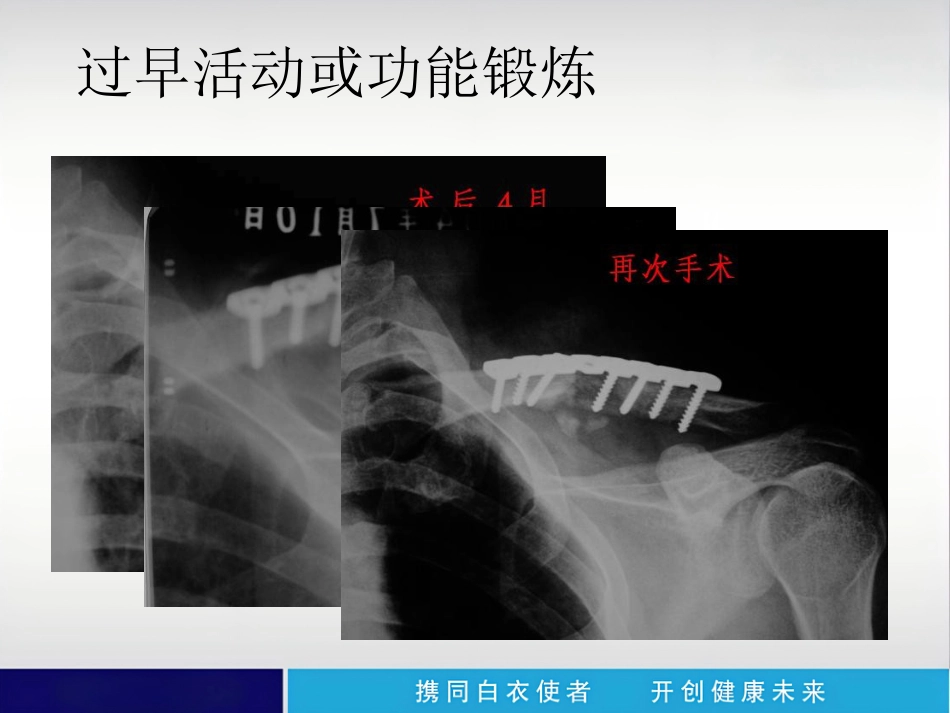 外科学：内植物断裂原因分析_第8页