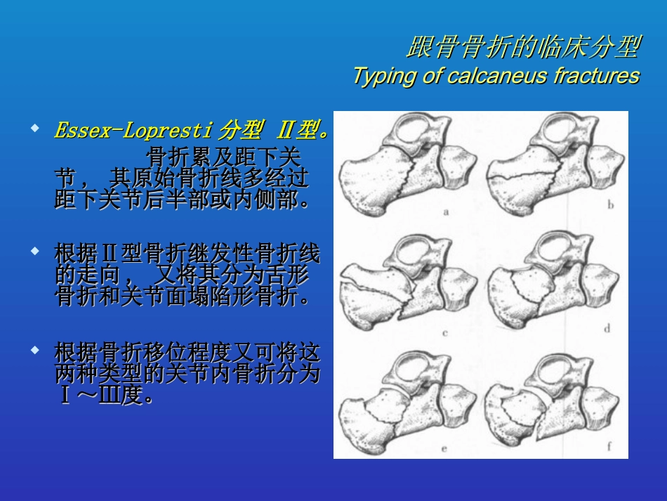 外科学：跟骨骨折的分型与治疗_第12页