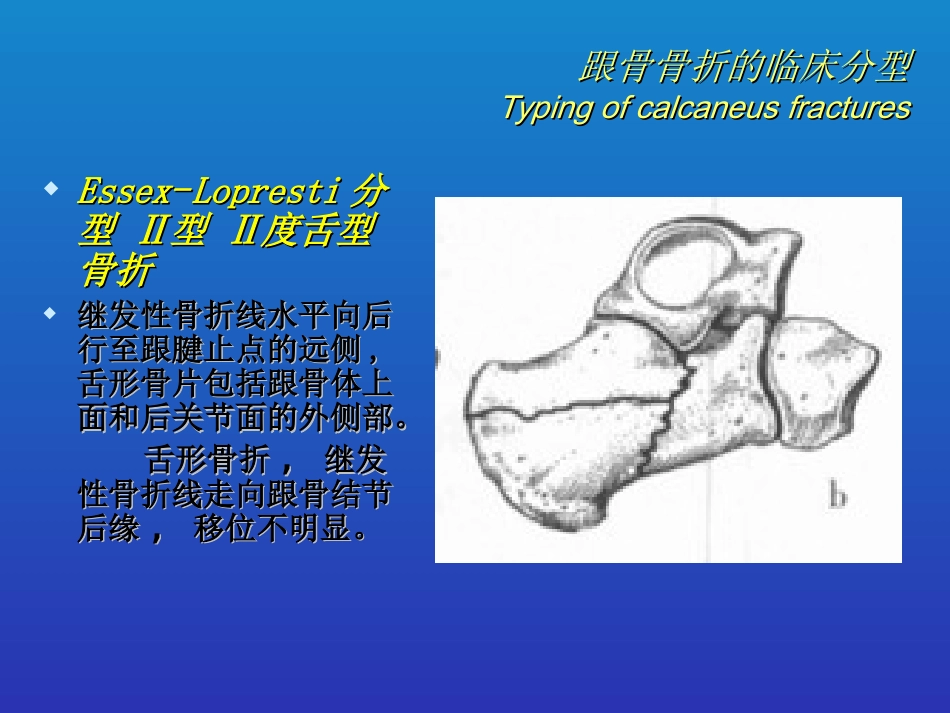 外科学：跟骨骨折的分型与治疗_第14页