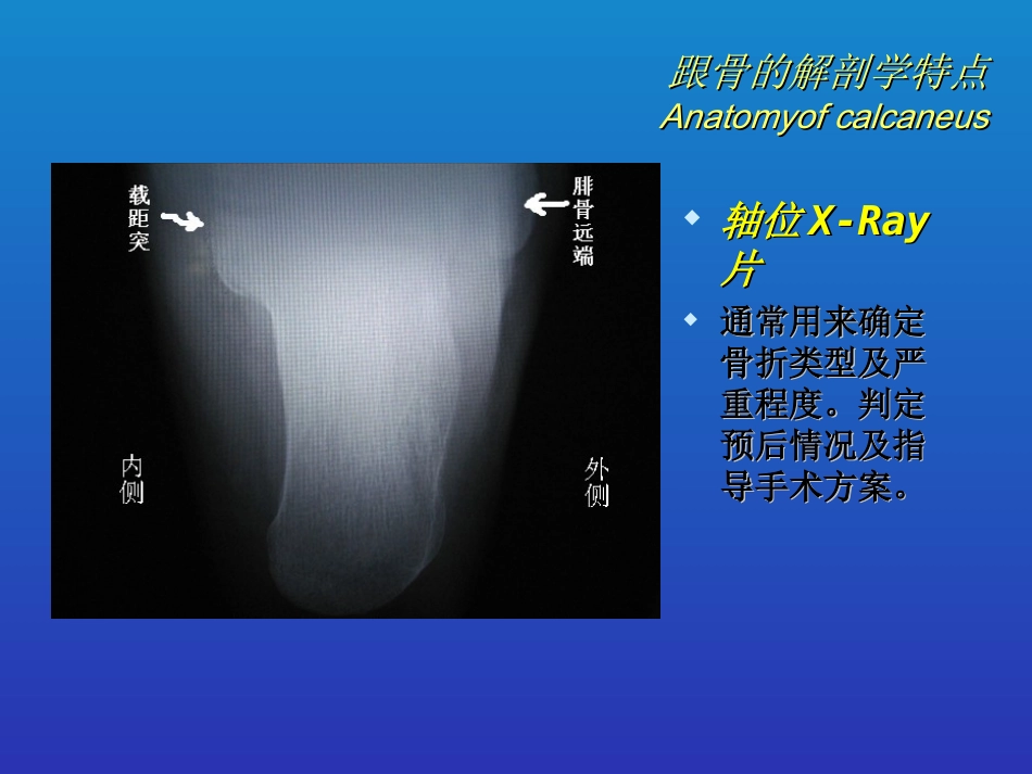外科学：跟骨骨折的分型与治疗_第4页