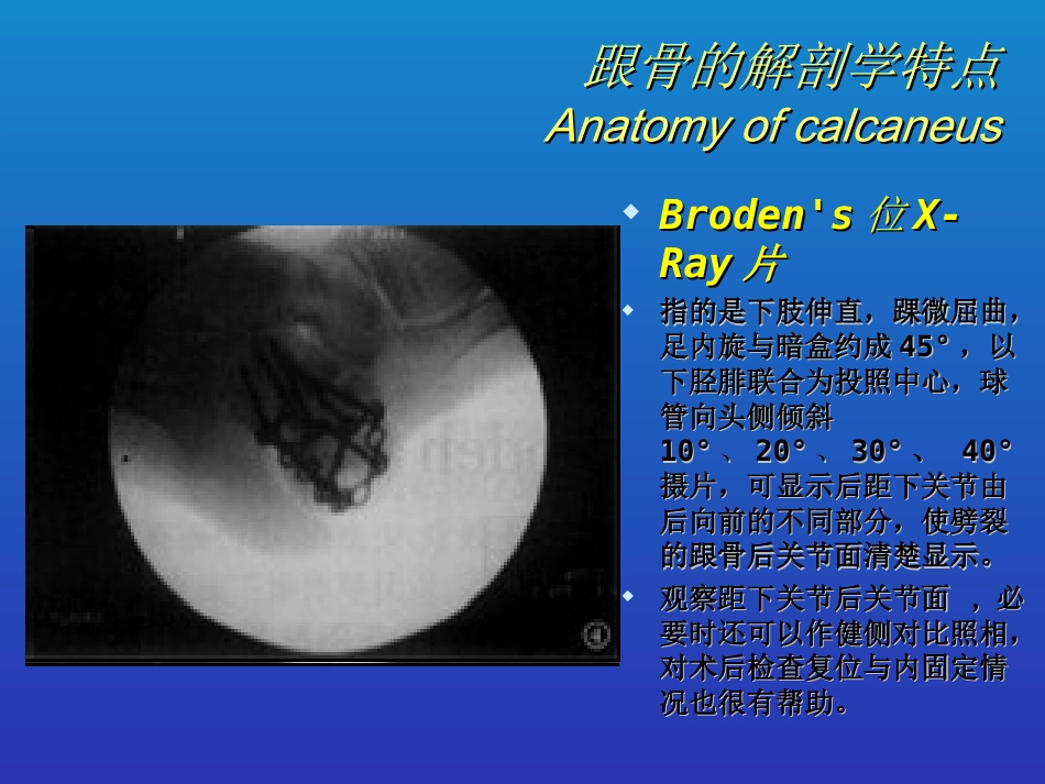 外科学：跟骨骨折的分型与治疗_第5页
