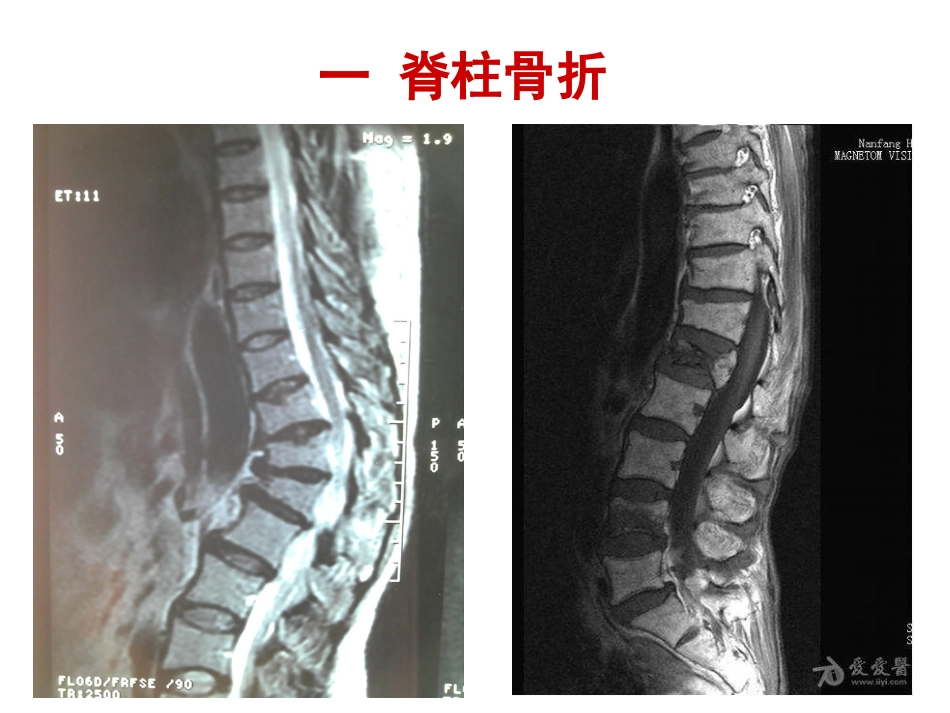 外科学：骨质疏松性骨折_第15页