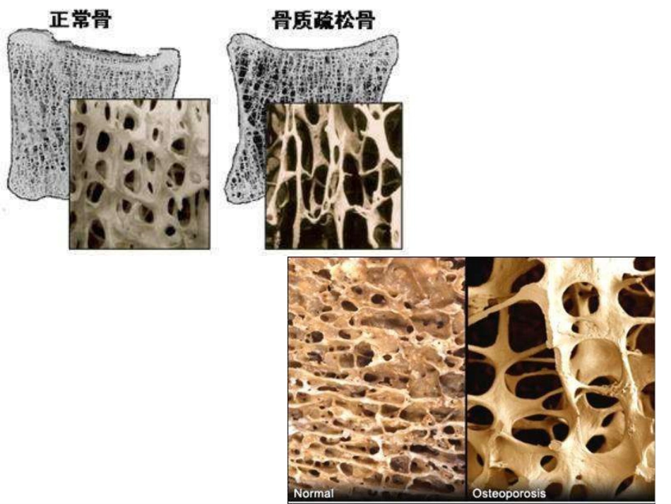 外科学：骨质疏松性骨折_第4页