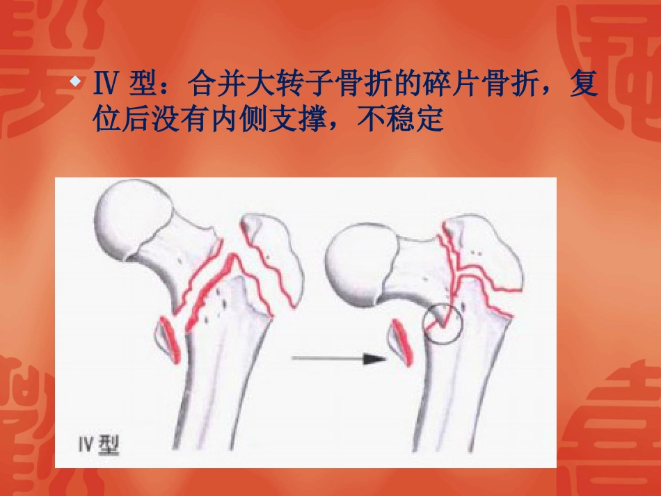 外科学：骨折常用分型_第10页