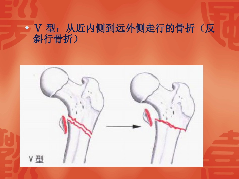 外科学：骨折常用分型_第11页