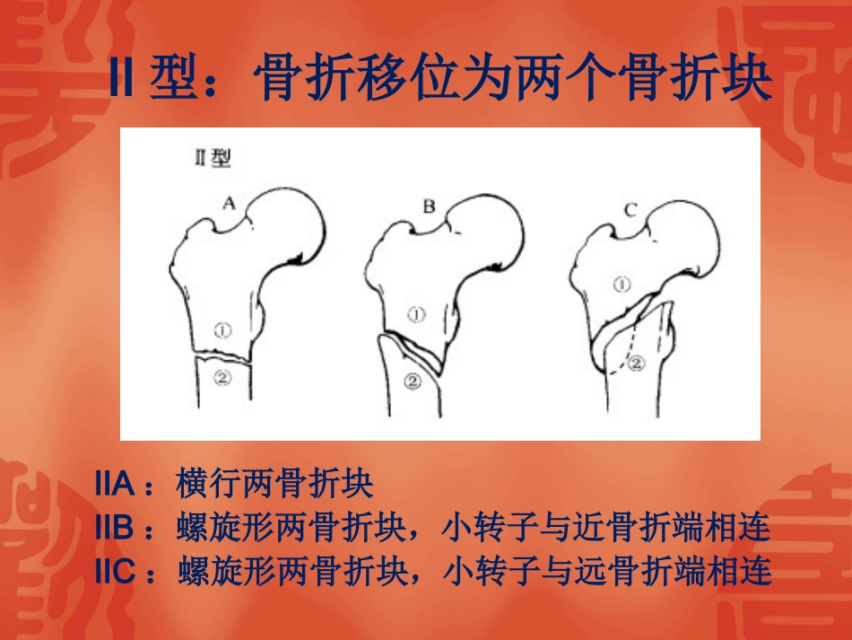 外科学：骨折常用分型_第14页