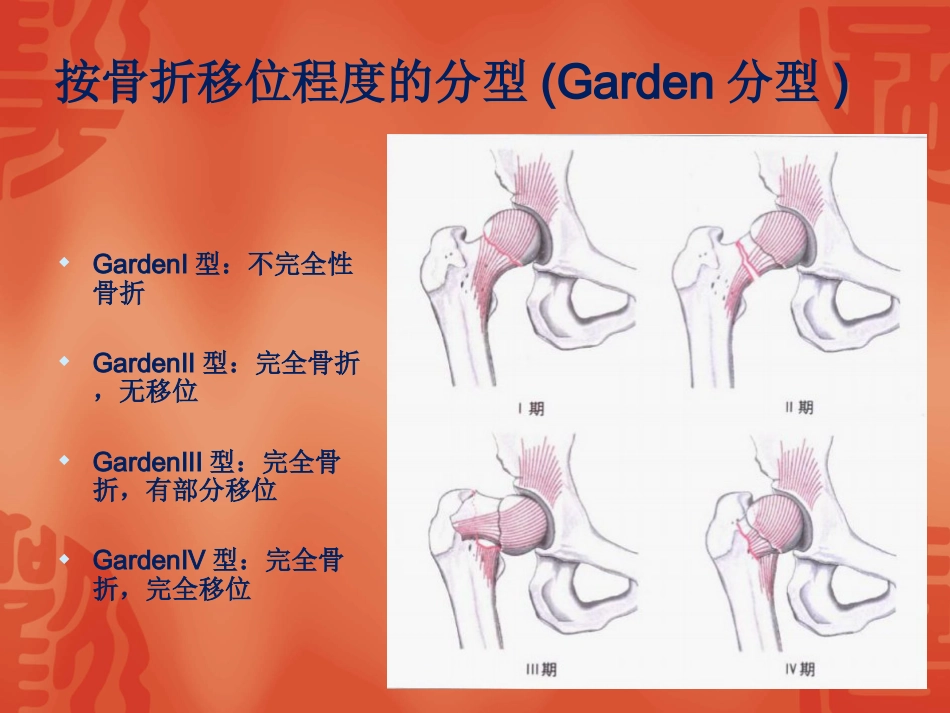 外科学：骨折常用分型_第5页