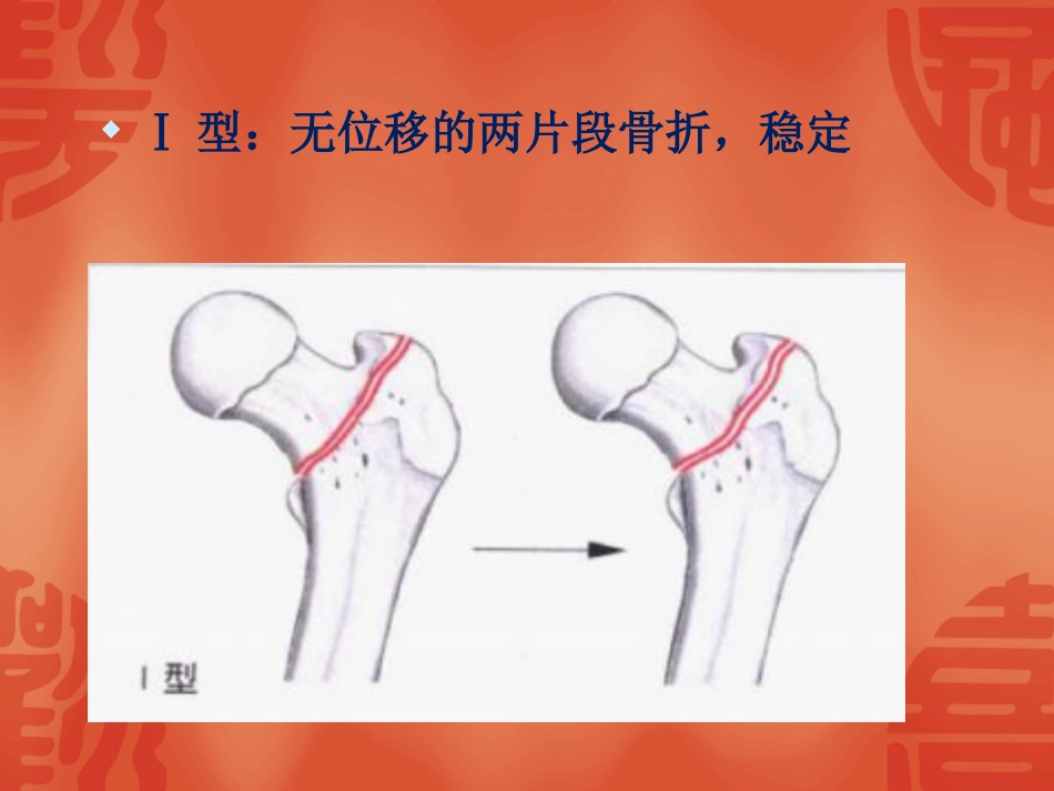 外科学：骨折常用分型_第7页