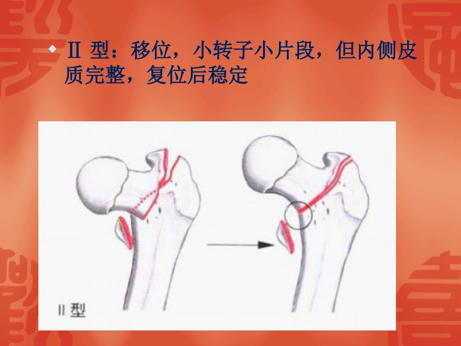 外科学：骨折常用分型_第8页