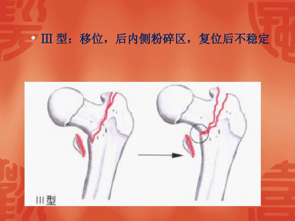 外科学：骨折常用分型_第9页