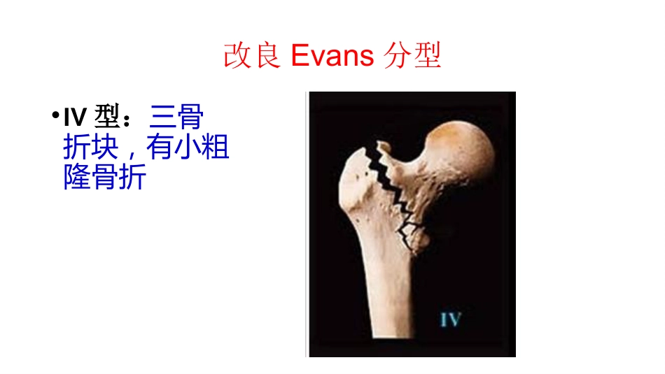 外科学：股骨粗隆间分型_第12页