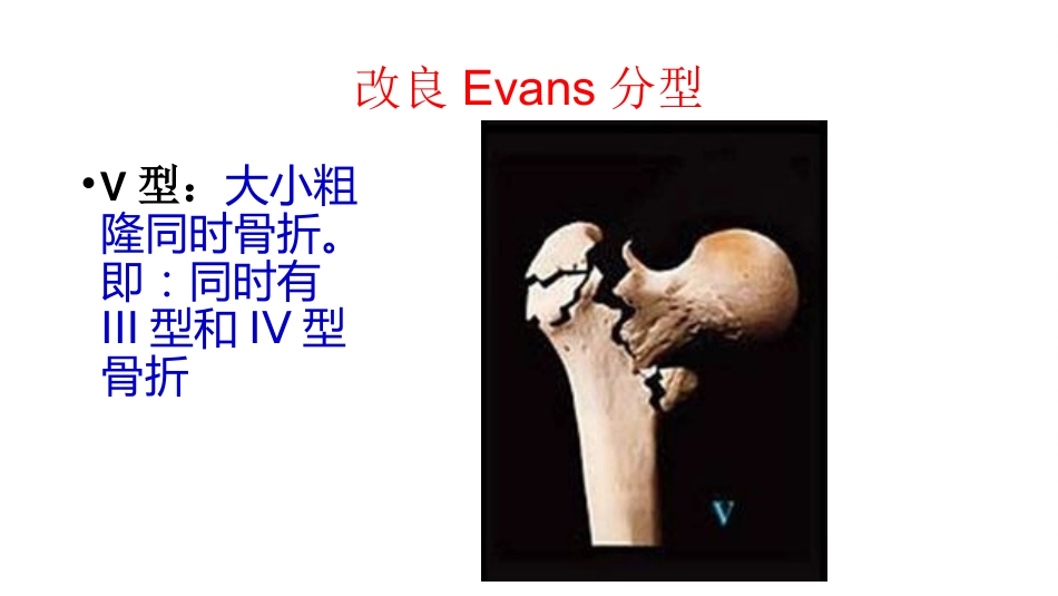 外科学：股骨粗隆间分型_第13页