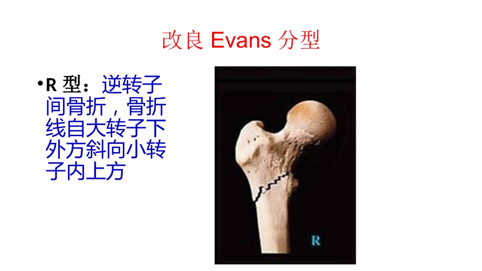 外科学：股骨粗隆间分型_第14页