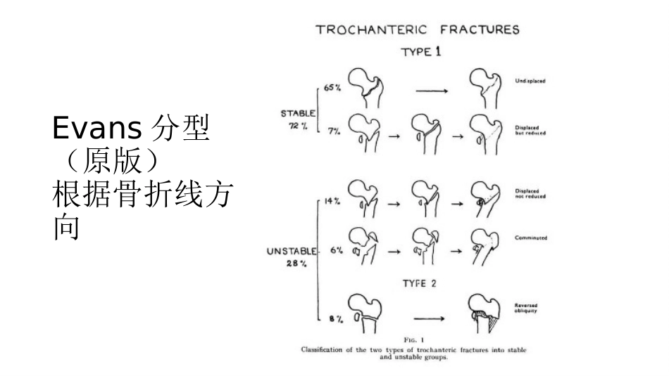 外科学：股骨粗隆间分型_第5页