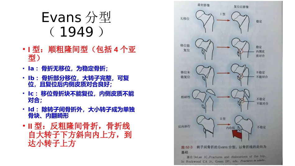 外科学：股骨粗隆间分型_第6页