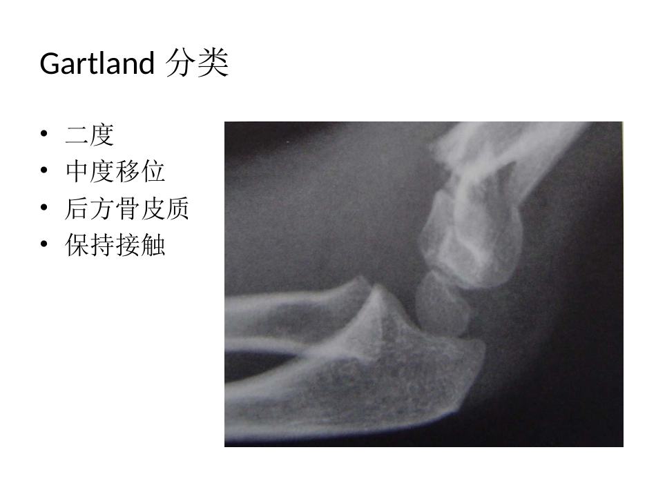 外科学：小儿肱骨髁上骨折_第10页