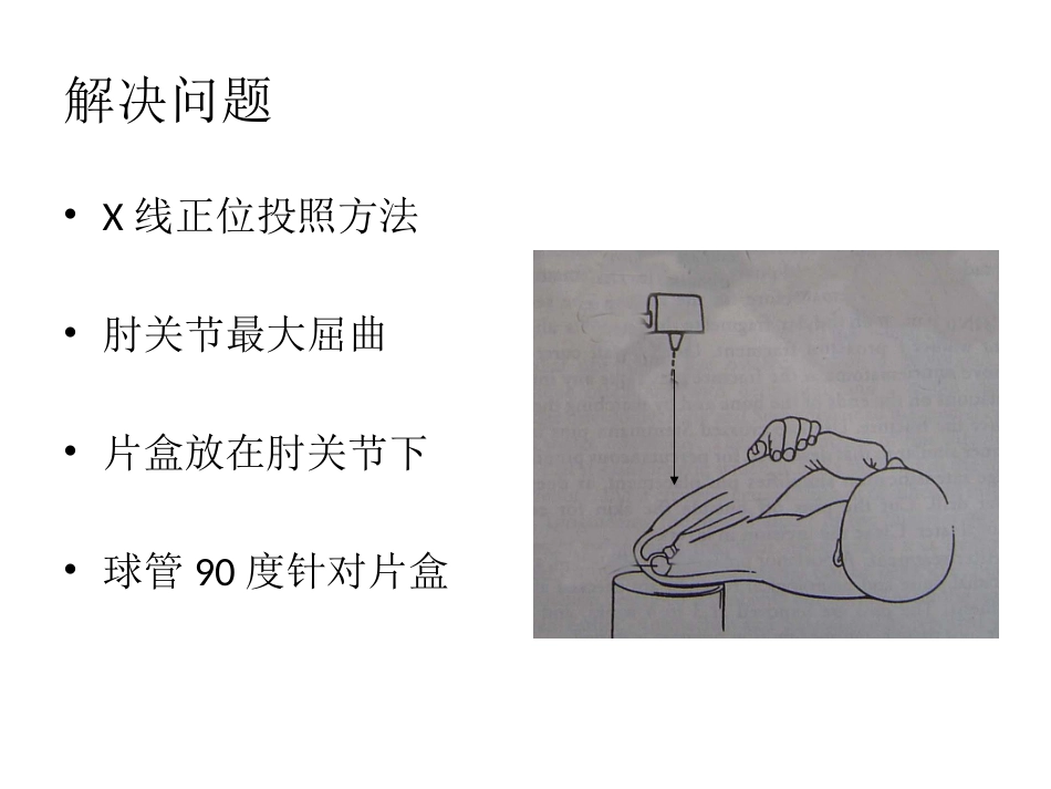 外科学：小儿肱骨髁上骨折_第15页
