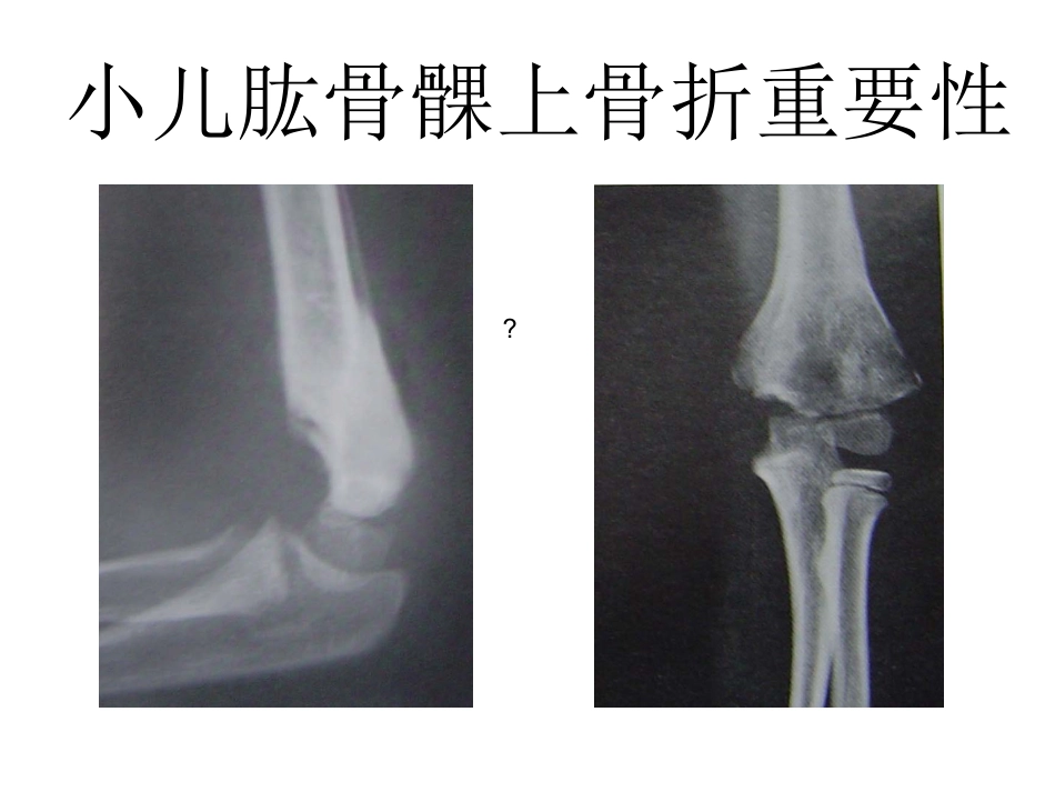 外科学：小儿肱骨髁上骨折_第2页