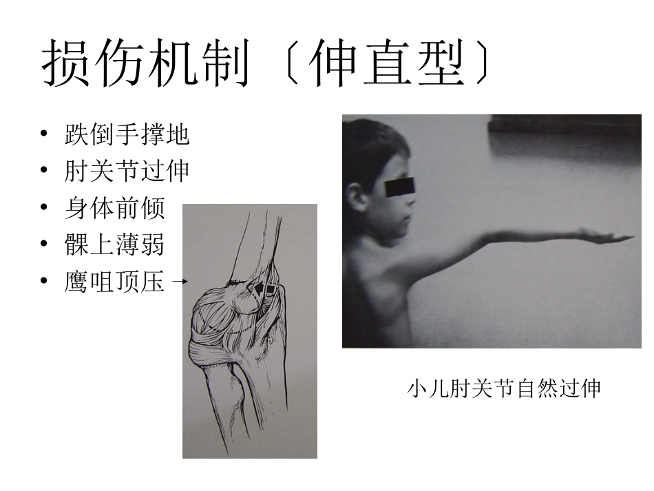 外科学：小儿肱骨髁上骨折_第6页