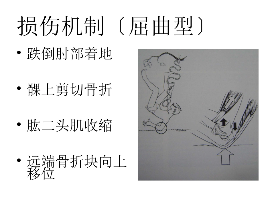 外科学：小儿肱骨髁上骨折_第7页
