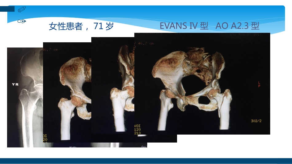 外科学：股骨粗隆间及粗隆下骨折髓内固定辅助技术分享_第14页