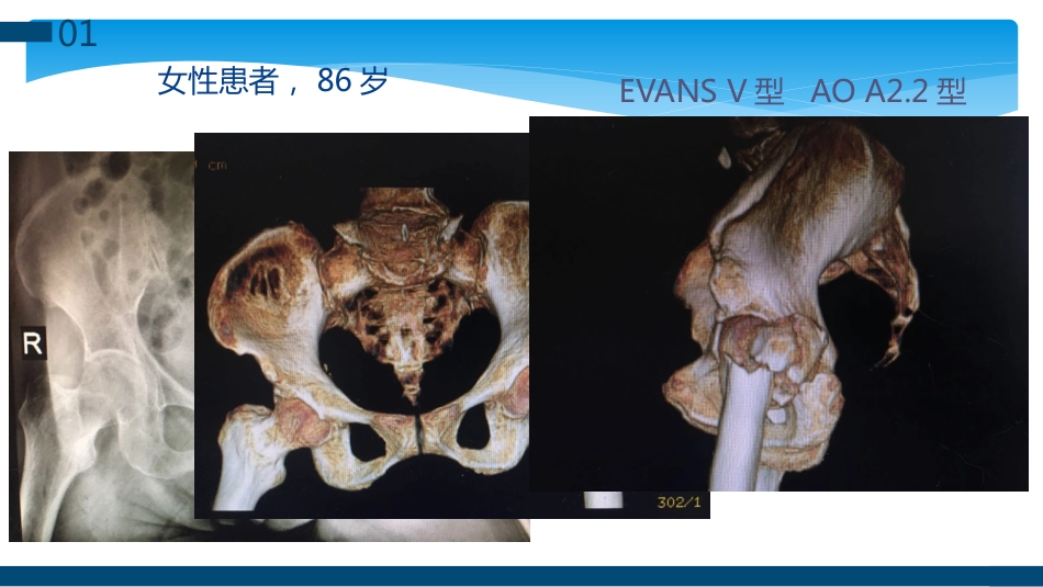 外科学：股骨粗隆间及粗隆下骨折髓内固定辅助技术分享_第4页